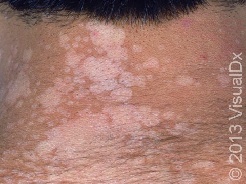 This image displays multiple circular, lighter, slightly scaling areas running into each other typical of tinea versicolor.