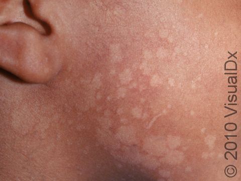 This image displays tinea versicolor affecting the face and neck.