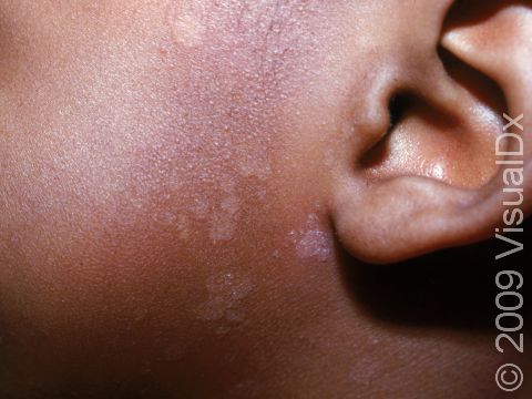 The subtle scaling can be seen in the spot of tinea versicolor near the earlobe.