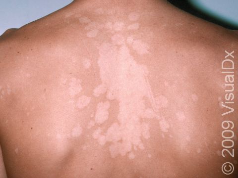 This image displays the flat and minimally scaly, well-defined light and dark lesions typical of tinea versicolor.
