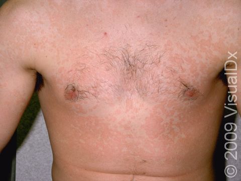 This image displays widespread, slightly elevated lesions due to a severe case of tinea versicolor.
