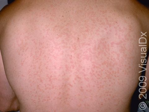 This image displays widespread, slightly elevated, scaly lesions on the back.