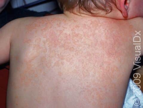 This lighter-skinned child displays round, pink patches of tinea versicolor.