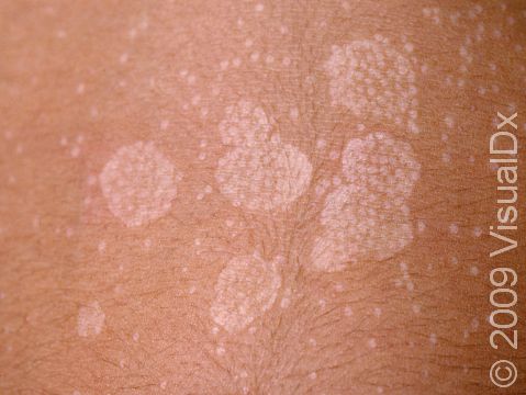 Tinea versicolor features lighter (hypopigmented), flat lesions with a very fine scale.
