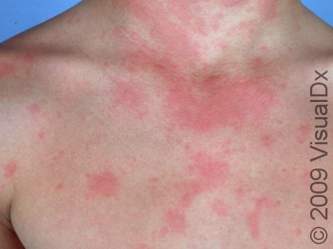 This image displays urticaria (hives) due to an allergic reaction.
