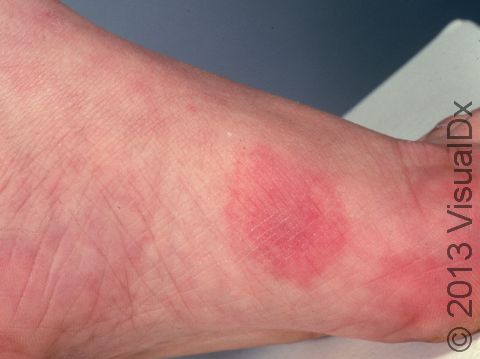 This image displays a red area of swelling on the foot typical of urticaria.
