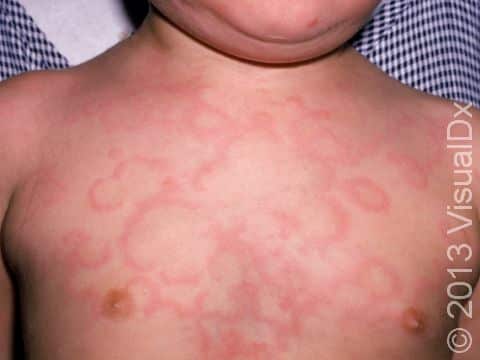 This image displays circles, arcs, and snake-like curves typical of urticaria (hives).