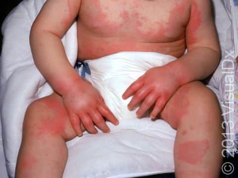 Urticaria (hives) is a sign of an allergic reaction, often caused by a medication or food allergy.