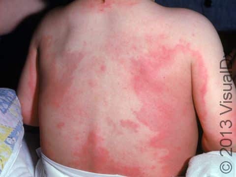 This image displays broad areas of redness typical of urticaria (hives).