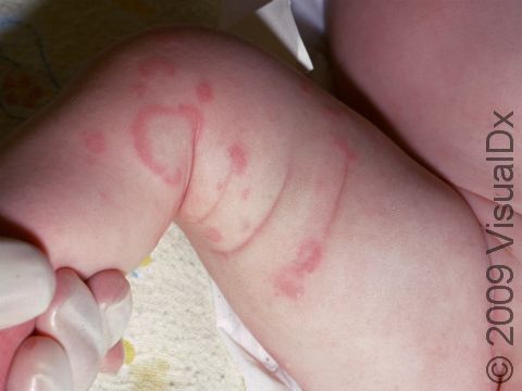 Urticaria (hives) can have pink, ring-like shapes.