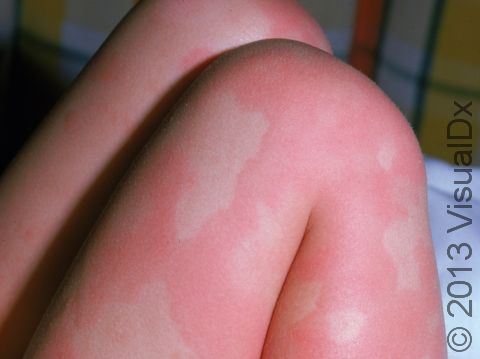 Urticaria (hives) can consist of large areas of redness and welt-like skin lesions.