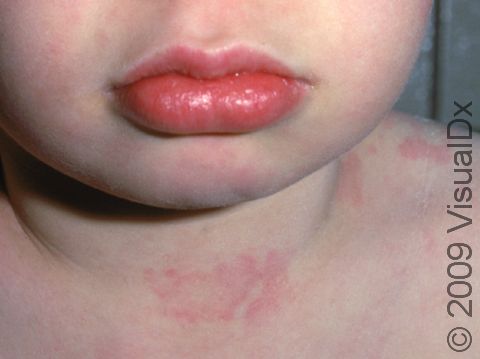 This image displays urticaria (hives) affecting the neck, face, and shoulders.