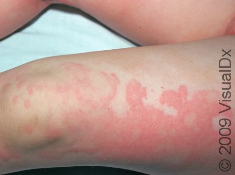 This image displays pink areas of a rash surrounded by lighter areas (due to constriction of blood vessels) typical of urticaria (hives).