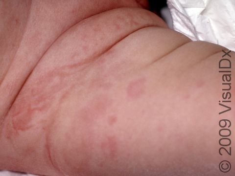 Urticaria (hives) can have pink lesions with gradual or sharp edges.