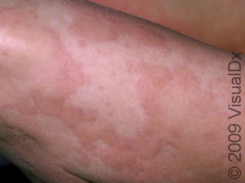 This image displays urticaria (hives), which develops quickly and is typically accompanied by an itch.