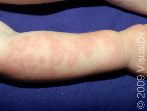 This image displays how urticaria (hives) often looks lighter in the center of the welts.