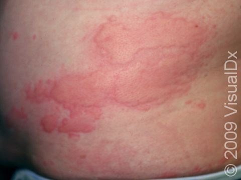 Hives (Urticaria) Condition, and Pictures Adults - Skinsight