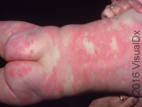 Urticaria (hives) can be extensive, forming large areas of redness.