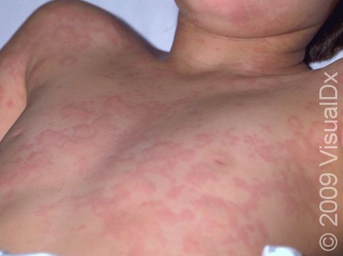 This image displays widespread urticaria (hives).
