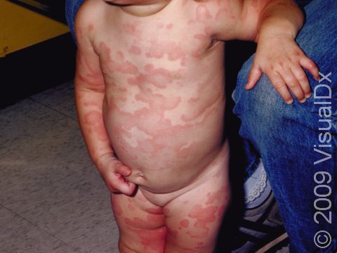 Urticaria (hives) can have red and pink slightly elevated lesions with rings, arcs, and scallop-edged shapes.