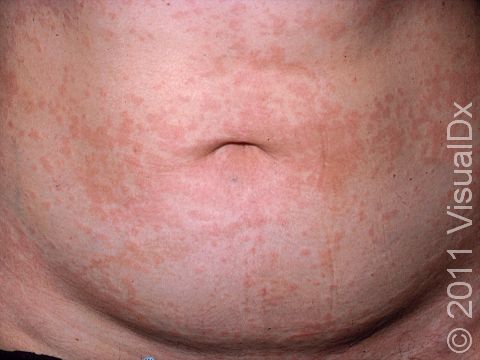Urticaria is the medical term for hives. Hives can be extensive and will appear to 