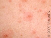 Chickenpox (Varicella) – Child