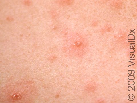 This image displays red bumps with a depression in the center typical of varicella (chickenpox).