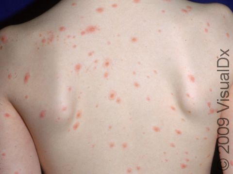 The blisters (vesicles) of chickenpox (varicella) can be widely scattered, as seen in this child.