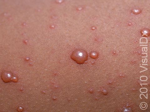 The blisters of varicella (chickenpox) are usually small and filled with a clear fluid.