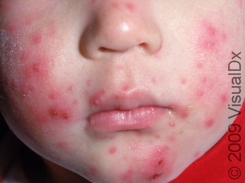 This image displays blisters typical of varicella (chickenpox), with scratched blisters at the chin.