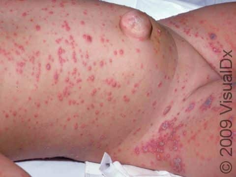 This image displays widespread blisters on an infant with varicella.