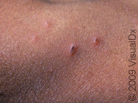 The blisters of varicella (chickenpox) quickly develop crusts and scabs as they heal.