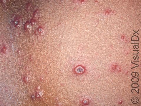 This image displays blisters in different stages, typical of varicella (chickenpox).