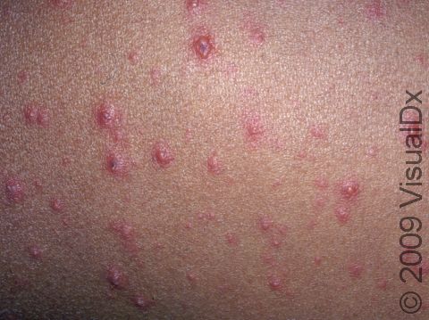 The blisters of varicella (chickenpox) often have a pink or red base.