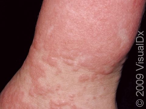This image displays typical pink-to-red elevations of the skin and nonscaling, slightly elevated lesions on a patient with a viral exanthem.