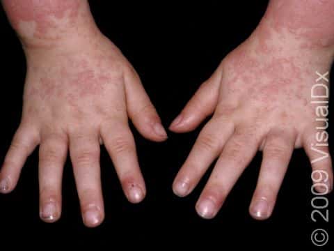 On a person with a viral exanthem, the pink-to-red, slightly elevated lesions on the skin can become widespread.