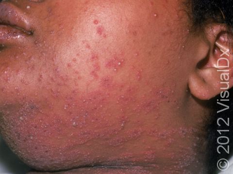 This image displays how a viral rash with tiny blisters may affect the mucous membranes (see the lips).