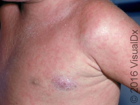 Widespread red or pink spots and patches, which may or may not be itchy, are typical of a viral rash.