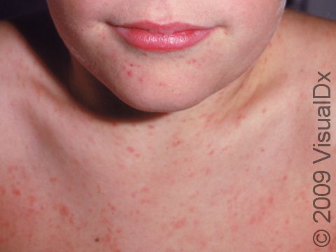 This child has numerous small, red bumps typical of a viral exanthem.