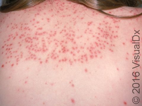 This image displays how sun exposure worsens a viral rash, as in this child on the upper back.
