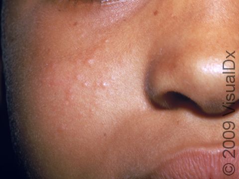 The small pink bumps of a viral exanthem may be harder to see on people with darker skin.