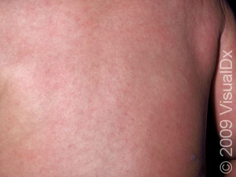 This image displays pink areas typical of viral exanthem.