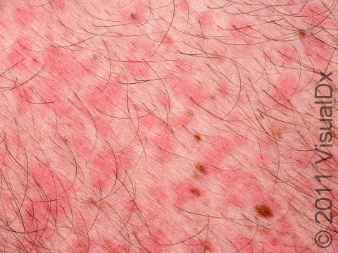 As displayed in this image, the pink-to-red elevations of the skin from viral exanthem are not scaly.