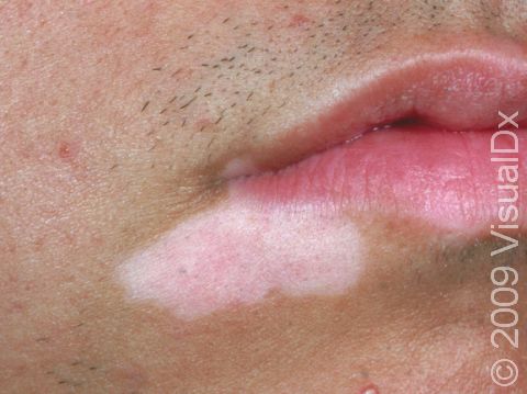 This image displays one spot of lightened pigment due to vitiligo.