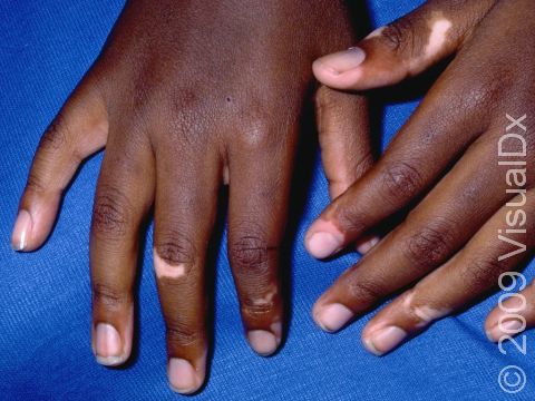 Vitiligo is an autoimmune condition that results in flat areas of pigment loss. Fingers are a common location.