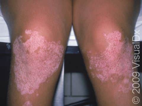 This image displays lightening of the skin due to vitiligo, with pigment beginning to return around each hair follicle.
