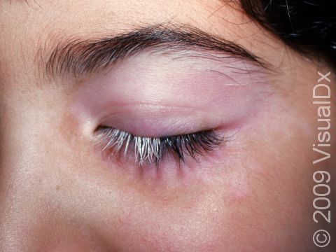 While the pigment loss from vitiligo is often subtle in lighter-skinned people, the loss of pigment from hairs in the eyelash area here accentuates the color loss.