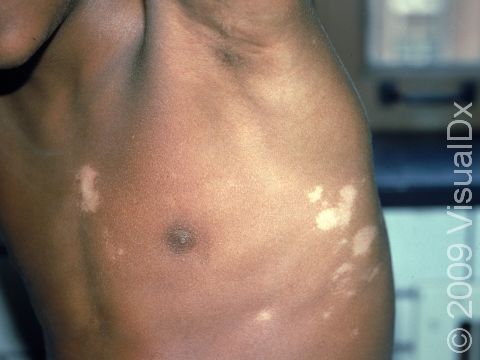 In people with darker skin, the pigment loss in vitiligo is easily apparent.