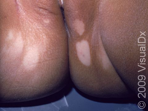 The white areas of pigment loss in vitiligo are easily seen in darker-skinned individuals; the genital area is commonly affected.
