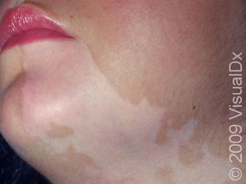 The pigment loss from vitiligo is often subtle in lighter-skinned individuals.